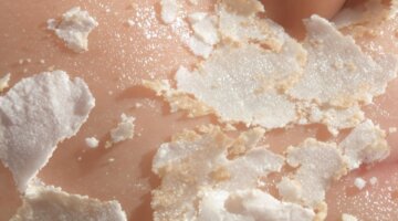 Pele descascada com textura exposta e saudável por baixo.