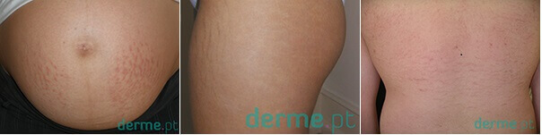 Tratamento para estrias