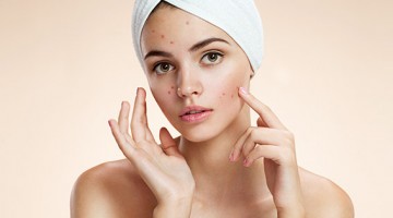 tratamentos para o acne