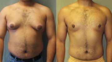 Ginecomastia